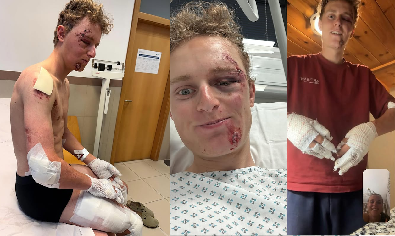 Lidl-Trek rider Albert Philipsen Mummified in Bandages after an 80kph Training Crash